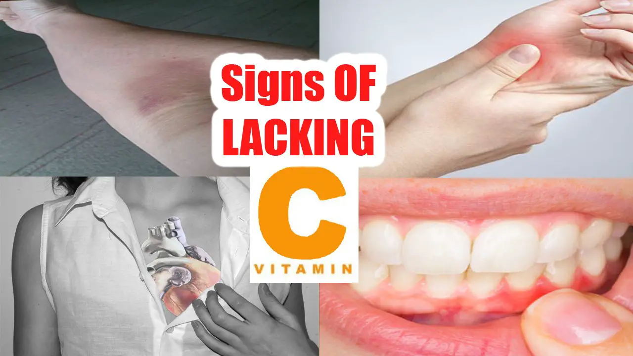 15 Signs and Symptoms of Vitamin