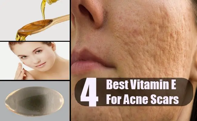 4 Vitamin E For Acne Scars