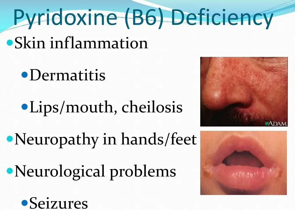 Deficiency of Vitamin B6 (Pyridoxine) â daneelyunus