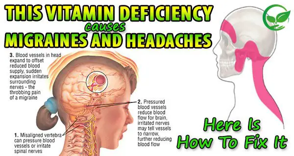 Does Vitamin D Deficiency Cause Migraines