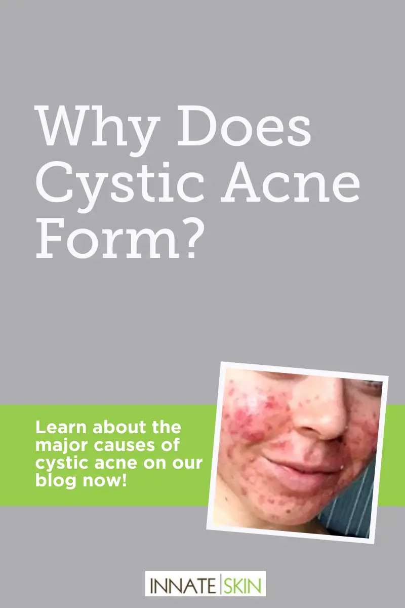 How Do I Get Rid Of Cystic Acne?