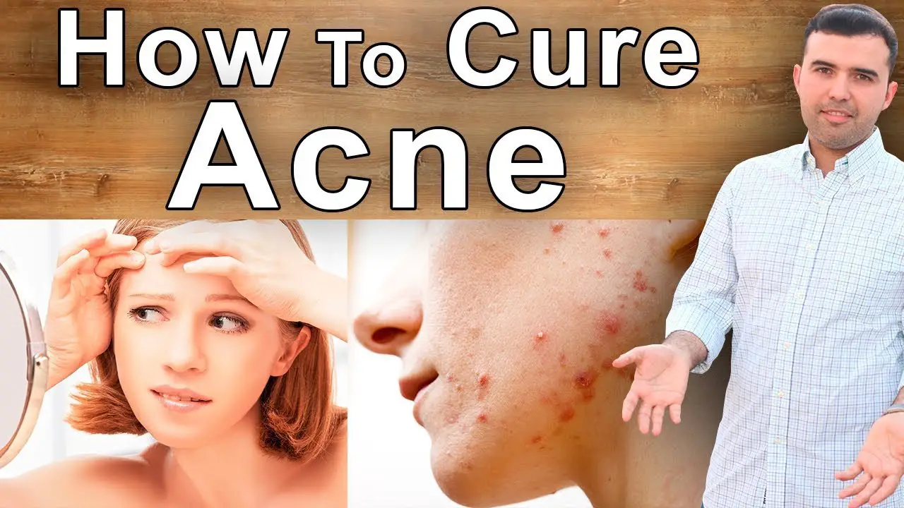 How to Cure Acne Naturally â Best Diet, Supplements and Vitamins