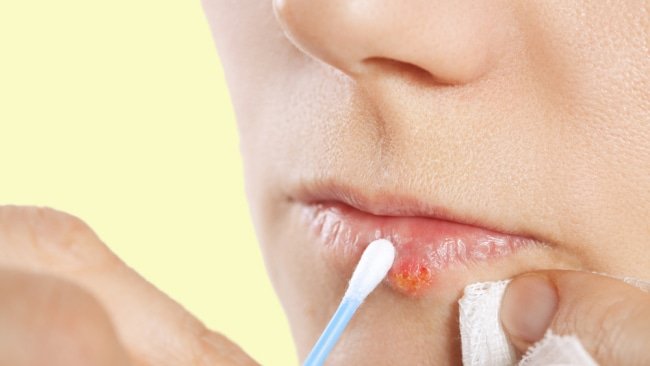 How to treat cold sores