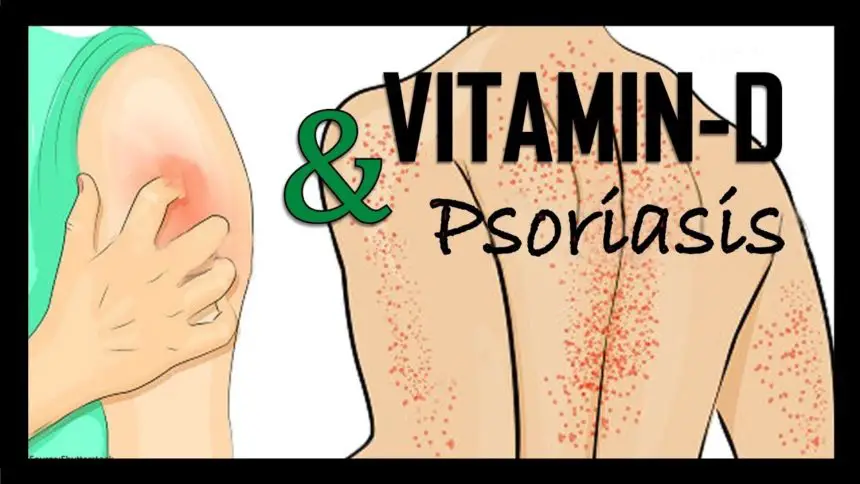 psoriasis and vitamin d dr health clinic