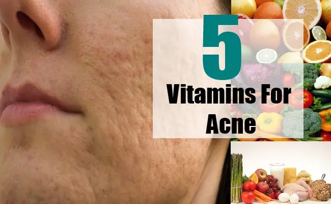 Top 5 Vitamins For Acne