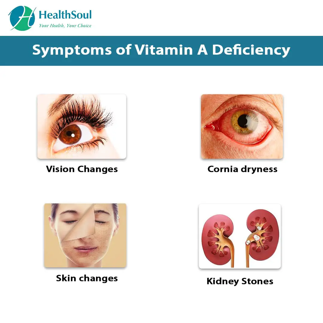 Vitamin A Deficiency  Healthsoul