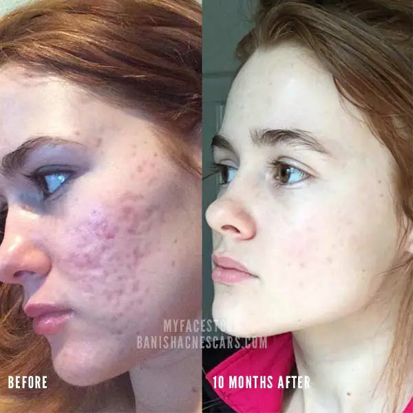 Vitamin C For Acne Scars Before And After