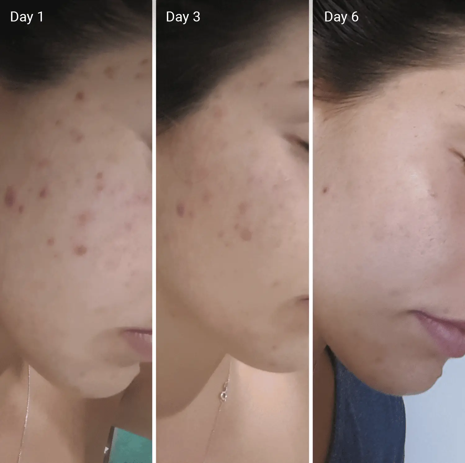 Vitamin C for Acne Scars: Efficacy, How It Works, Before and Afters