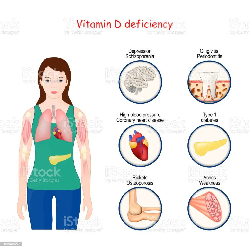 Vitamin D Deficiency Human Body And Closeup Of Organs With Effects Of ...