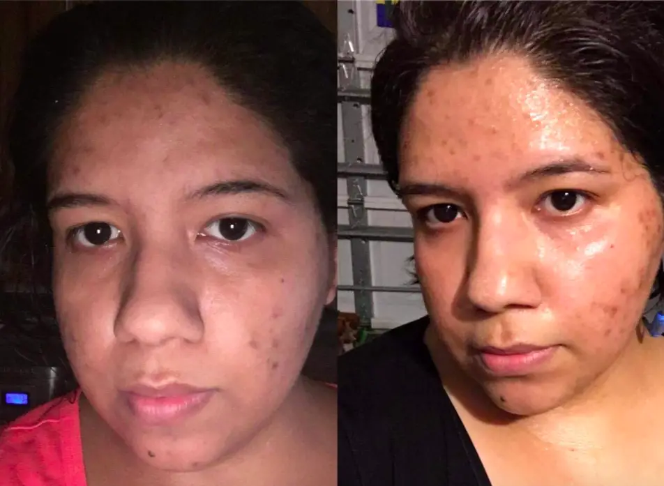vitamin e for acne scars before and after