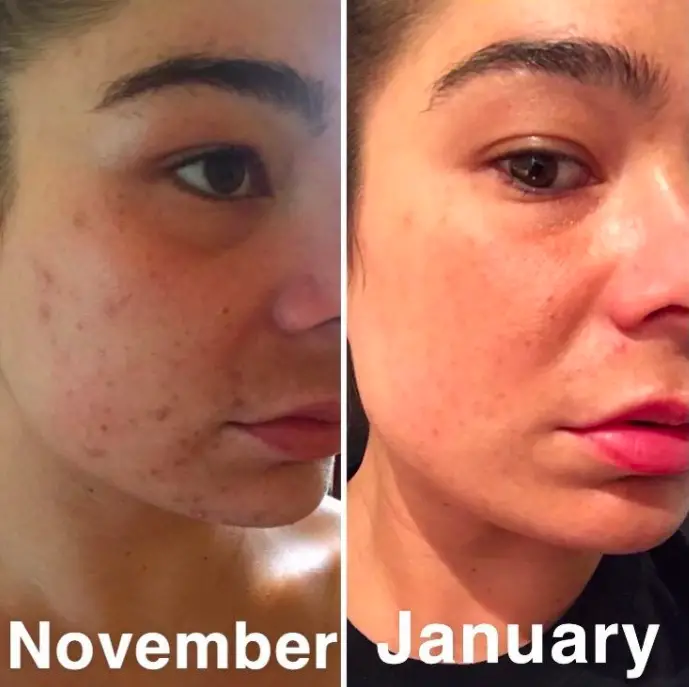 Vitamin E For Acne Scars Before And After