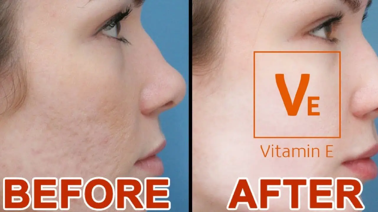 Vitamin E For Acne Scars
